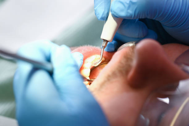 Best Broken or Chipped Tooth Repair in Northampton, PA